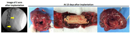 [두번째 시도] 이식 후 C-arm을 통한 확인. 이식 15일 후, 적출 한 기관+지지체의 모습. 기관 지지체와 만나는 양 말단에서 stenosis가 진행된 모습