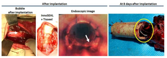 [세번째 시도] 기관 지지체 이식 후, 지지체 말단에서 공기가 새는 모습 및 InnoSEAL과 Tisseel을 이용하여 말단을 sealing한 모습. 내시경을 통하여 관찰한 이식 후 모습 (화살표: sealing을 했음에도 불구하고 공기가 새는 곳). 이식 8일 후, 적출한 기관+지지체의 모습.기관 연골링 사이가 찢어진 것을 확인 (Yellow circle)