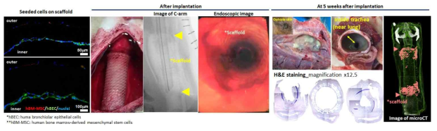 [네번째 시도] 기관 지지체 바깥면에 도포된 골수유래줄기세포 (human bone marrow-derived stem cells, hBM-MSC)와 안쪽면에 도포된 기관상피세포 (human bronchial epithelial cells, hBEC)의 모습. 세포들이 도포된 기관 지지체 이식 모습 및 C-arm과 내시경을 통한 이식된 지지체의 모습. 기관이식 5주 후, 이식된 기관 지지체 주변의 염증 모습 및 stenosis에 의해 좁아진 airway의 모습. H&E 염색을 통하여 확인된 기관 지지체 양말단의 stenosis 모습. MicroCT를 통해 확인한 이식된 기관 지지체의 모습
