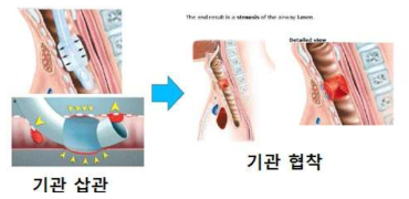 기관 손상의 주된 원인인 기관 삽관과 그 결과 발생하는 기관 협착