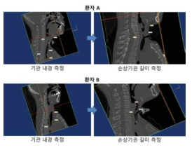 임상 환자의 폐쇄된 기관지의 DICOM data