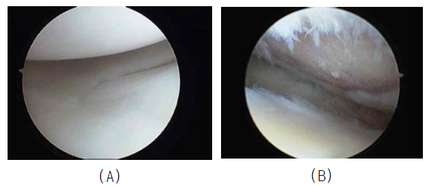 사람의 정상무릎관절(A)과 광범위한 연골 손상 무릎관절(B)의 관절경 사진