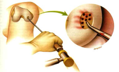 골수자극술. 연골 결손 부위에서 연골하골까지 작은 구멍을 뚫어 골수줄기세포가 연골 결손 부위로 흘러나와 연골을 재생하는 방법 (출처: www.thekneedoc.co.uk)