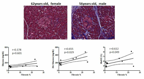 췌장암 환자 조직에서 fibrosis와 혈당 상승 인자와의 correlation 확인