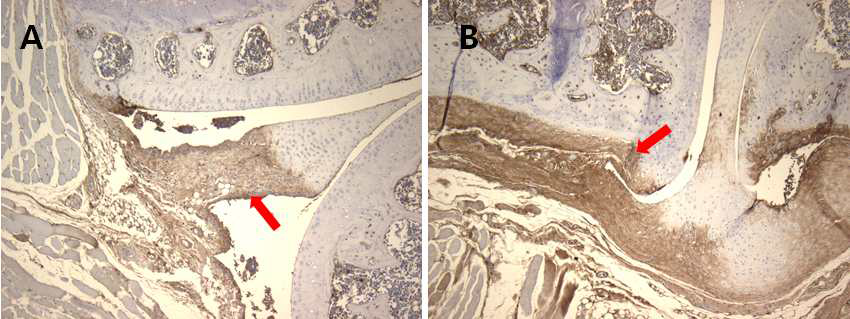 Immunohistochemistry for TNF-α and TGF-β1 expressions in joint section. A. The early stage of inflammation characterized by enthesial inflammation and cellular proliferation and immunoreactivity for TNF-α is detected. B. Osteoproliferation of articular surface was noted at late stage and immunoreactivity for TGF-β1 was seen