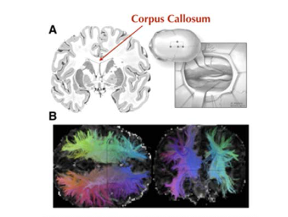 A. 뇌량의 위치와 뇌량절제술의 모습. 뇌량은 좌뇌와 우뇌를 연결하는 신경다발의 집합체. B. 뇌량절제술을 시행한 환자의 DTI영상. 절제술로 인하여 뇌량의 신경다발이 모두 끊어진 형태임을 확인 할 수 있음