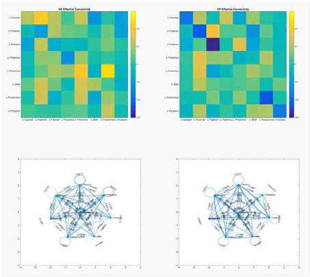 유효인과성 연결망 비교. (좌) 정상군, (우) 환자군