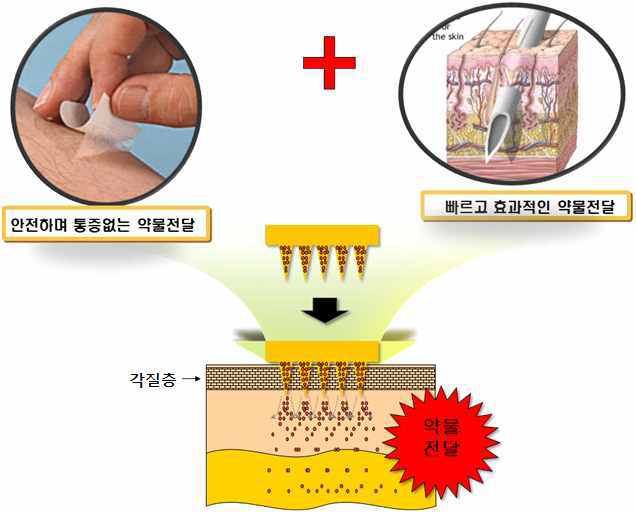 생분해성 마이크로니들의 약물전달 기작