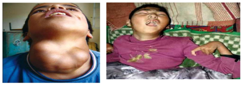 요오드 결핍증으로 인한 갑상선 비대증에 시달리는 아이들