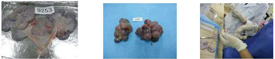 (왼쪽)적출된 자궁 (가운데)난소 내 황체 (오른쪽)난관 및 자궁 관류