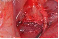 Carotid artery defect model에 실크 매트릭스 적용