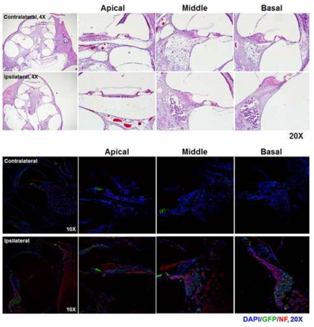 Neural differentiation of human induced neural stem cells in auditory system of hearing loss model mouse