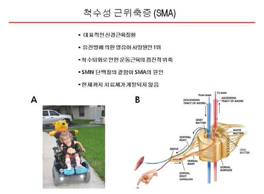 척수성 근위축증은 대표적인 유전성 근육질환 (A) 영유아의 유전병에 의한 사망원 1위인 치명적인 질병임. (B) 척수가 퇴화되면서 운동근육이 점차적으로 위축되고 종국에는 사망에 이르게 됨