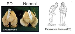 파킨슨병 환자중뇌와 정상인의 중뇌 (왼쪽) 및 파킨슨병 환자의 증상 모식도(오른쪽)