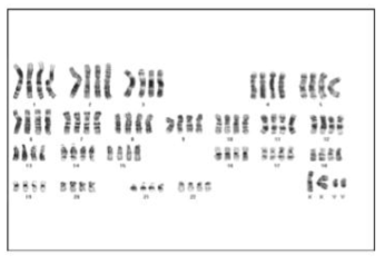 Karyotype analysis of ND29968-iNSC