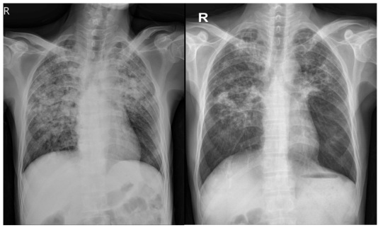 Chest radiograph (Lt. : initial // Rt. : 3 month after treatment) Lt. : Multifocal area of consolidation and nodular opacities in both lung, predominantly BULF -> Active pulmonary tuberculosis Rt. : Slightly decreased extent of the areas of consolidation and nodular opacities