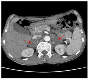 Abdomen CT, Enlarged low attenuating mass in both adrenal gland (arrow)