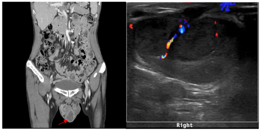 Abdomen CT(Lt.) & Rt. scrotal US(Rt.) scrotal abscess(arrow) and Rt. epididymo-orchitis