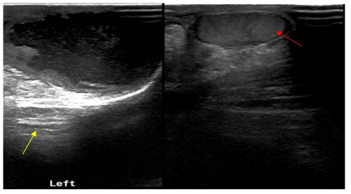 Scrotal US Scrotal abscess(yellow arrow) & intact Lt. testis(red arrow)