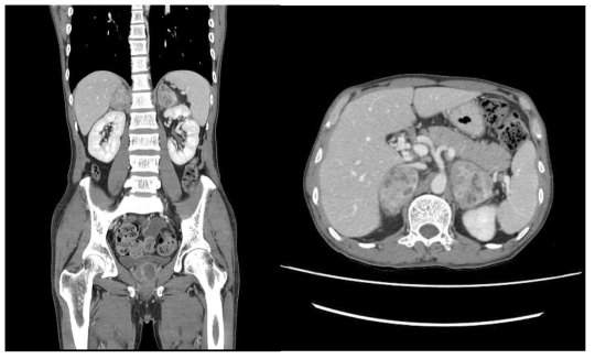 Abdomen CT r/o Adrenal Tb, Renal and bladder Tb with abscess formation