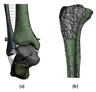 인대결합 나사를 삽입한 발목 관절의 유한요소모델 : 나사 삽입 (좌), 내부 단면 (우)