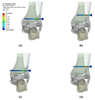 인대결합 나사의 삽입 높이, 피질골 관통 수에 따른 등가 응력 분포 높이 : 10 mm, 관통 수 3면 (a), 25 mm, 관통 수 3면 (b), 10 mm, 관통 수 4면 (c), 25 mm, 관통 수 4면 (d)