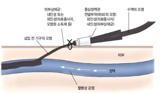 중심정맥관 관련 혈류감염 발생시 원인균의 유입경로