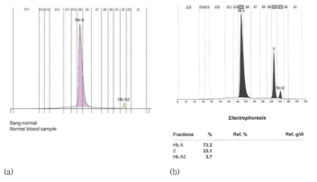 Pattern of hemoglobin electrophoresis. (a) normal hemoglobin, (b) abnormal hemoglobin