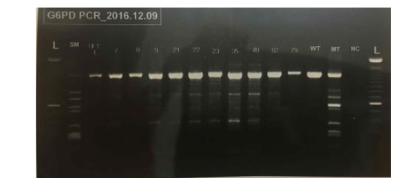 Pattern of G6PD deficiency genotyping