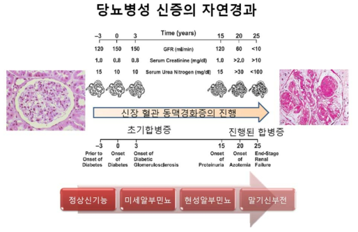 당뇨병성 신증의 자연 임상 경과