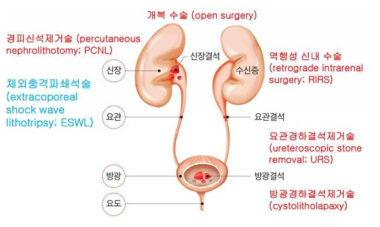 요로결석 개념도