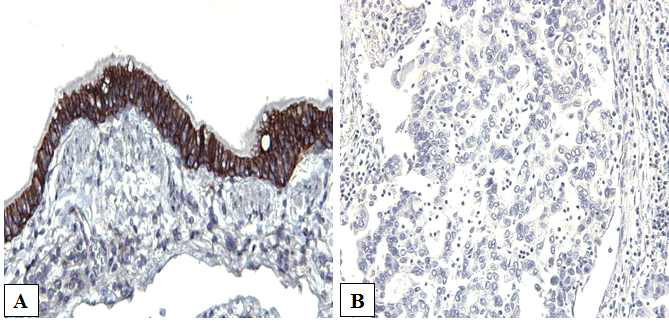bronchial epithelial 세포 (A)와 ROS1 발암유전자 변이군(B)에서의 E-cadherin 발현