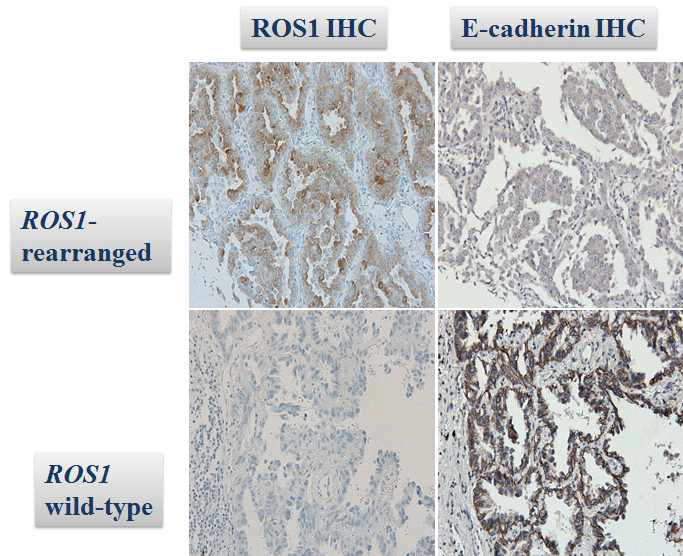 ROS1 발암유전자 변이에 따른 ROS1과 E-cadherin 단백질 발현