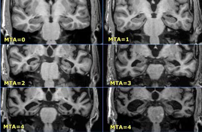 (출처)Scheltens, Eur Neurol 1997