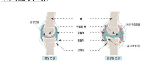 관절연골의 손상