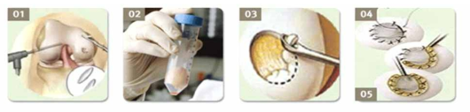 자가 연골세포 이식술 과정; http://maitrise-orthop.com