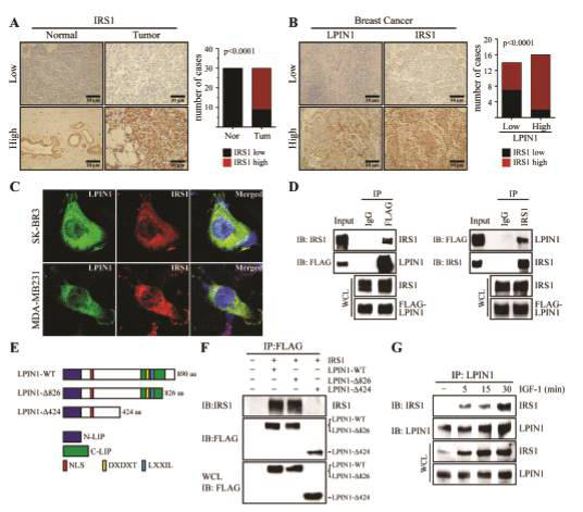 LPIN1 colocalizes and interacts with IRS1 in breast cancer cells