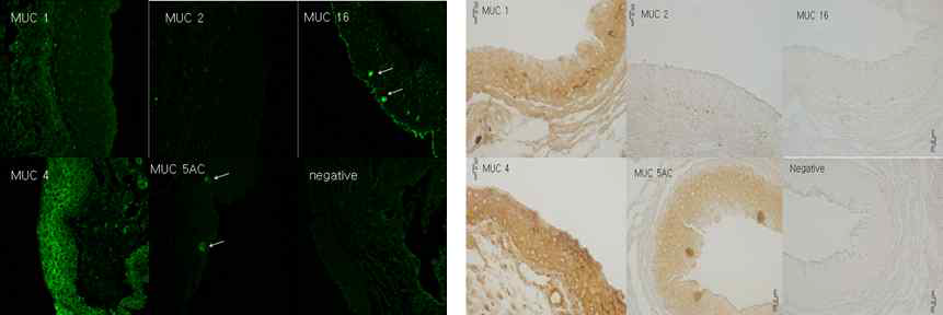 (좌) mucin immunohistochemical stain과 (우) ABC staining