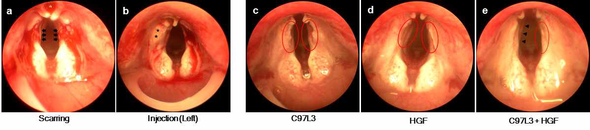 Microscissor를 이용하여 양측 성대에 scarring을 가한 후 좌측 성대에 injection을 시행하여 injection을 시행하지 않은 우측성대와 비교 분석함