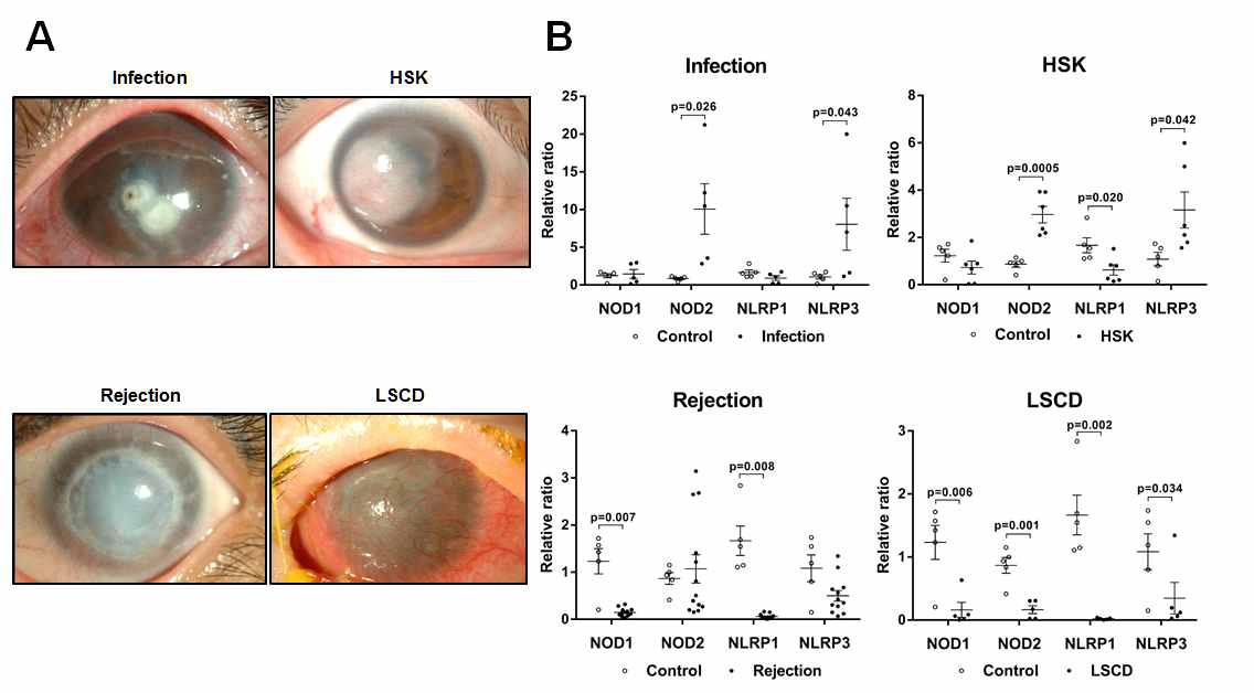 The mRNA levels of NLRs in human corneas with diseases. The corneas were removed during penetrating keratoplasty in patients with active corneal infection, corneal opacity due to previous herpes stromal keratitis (HSK), chronic allograft rejection, and corneal opacity due to limbal stem cell deficiency (LSCD) (A), and evaluated using real-time RT PCR for the expression of NOD1, NOD2, NLRP1, and NLRP3 (B). Data represent the relative ratio of mRNA levels to healthy control corneas, and are presented as mean ± SEM