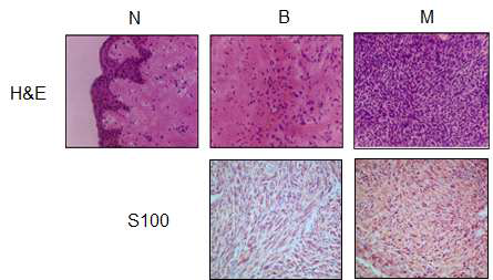 NF1 환자(P3)의 정상(N), 양성(B), 악성(M)조직에 대한 H&E staining, S100 IHC 결과