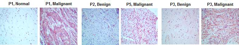 NF1 환자(P1, P2, P3)의 phospho-EGFR 항체를 이용한 IHC 결과