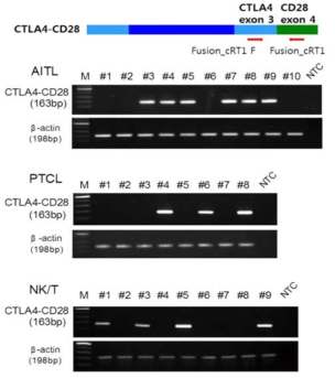 아형 별 환자 검체에서 RT PCR을 통한 CTLA4-CD28 변이의 유무 확인