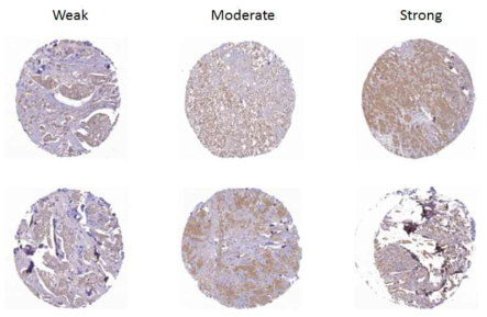 Immunohistochemistry for MT2A expression in breast cancer tissue. 152 breast cancer samples were stained with MT2A antibody and graded based on both staining intensity and staining frequency. Representative images of tissue microarray and immunohistochemistry are shown (Weak; moderate; Strong). Original magnification x 200