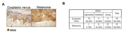 사람의 dysplastic nevus 및 melanoma 조직에서 DRG2 발현 분석
