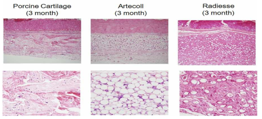 Inflammation and giant cells infiltration around injected materials at 3 months. (A) Artesense group have mild mononuclear cell infiltration, relatively increased average giant cell counts (10.1/400 HPF) and no neutrophils. (B) Radiesse group showed a decreased mononuclear cells and disappeared neutrophil infiltration. However the giant cell counts were markedly increased, more than 30 giant cells/400HPF. (C) Decellularized xenogenic cartilage group showed same level of inflammatory response (grade 1.3), markedly decreased neutrophil infiltration(0.04/400HPF), and slightly increased giant cell counts(1.2/400HPF)