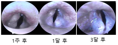 탈세포화된 연골의 주입후 성대의 내시경 소견