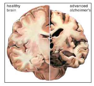 알츠하이머병에 의한 대량의 뇌 신경조직/세포사멸