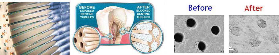 상아직지각과민증 치료제의 기전 및 사용전후 상아세공