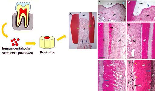 치아 줄기세포를 이용한 치수-상아질 재생치료